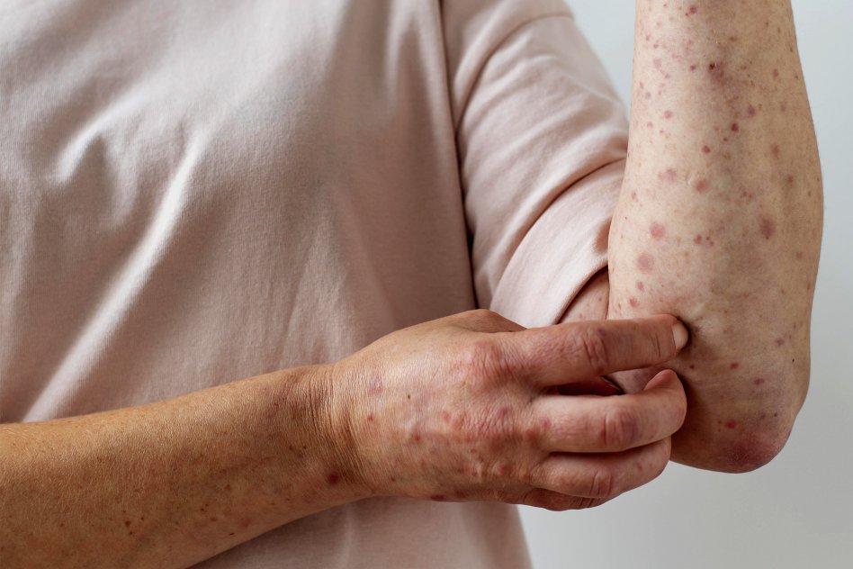 Salud emitió una alerta epidemiológica ante probable caso de sarampión en Villa del Rosario