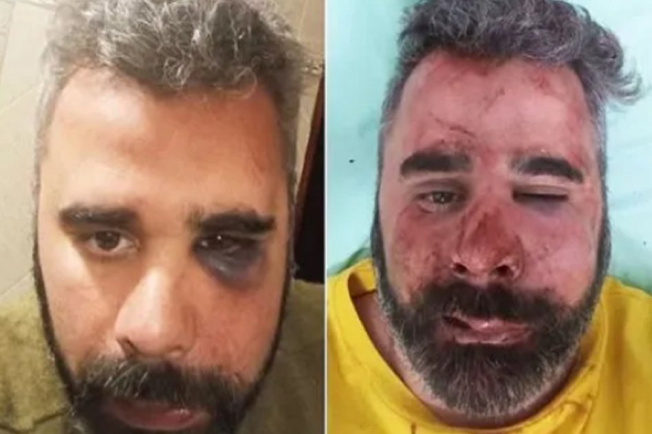 RECONFIGURACIÓN FACIAL Lo dejaron cual jubilado todos los miércoles. Golpearon al presidente del Partido Libertario de San José